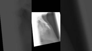 Minimally displaced nasal bone fracture xray [upl. by Airot]