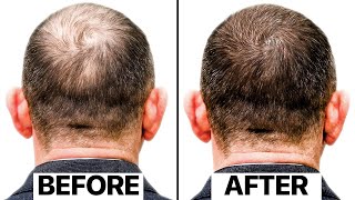 The Truth Behind This New Hair Loss Treatment  Exosomes [upl. by Leziar761]