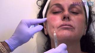 How To Use Blunt Cannula for Facial Fillers  Dr Paul Nassif [upl. by Tennos]