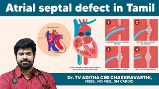 Atrial septal defect in tamil  treatment for atrial septal defect doctoradithacibi [upl. by Keverne340]