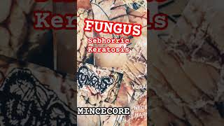 FUNGUS  SEBHORRIC KERATOSIS Mincecore Lovers VORACIOUS PRURITUS IN NECROTIC HARMONY EP [upl. by Atiuqat]