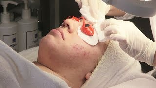 Acne Facial Treatment And Analysis [upl. by Janith]