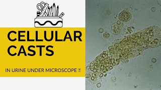 Urine Casts  Cellular Casts in Urine  What does cellular cast look like [upl. by Auguste]