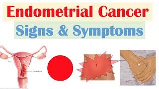 Endometrial Cancer Signs amp Symptoms amp Why They Occur [upl. by Portwine]