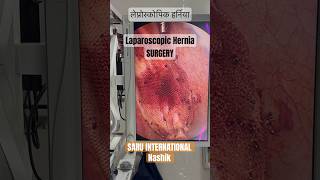 Hernia surgery Laparoscopic Hernia Surgery in Nashik Hernia hernia [upl. by Oflodur]