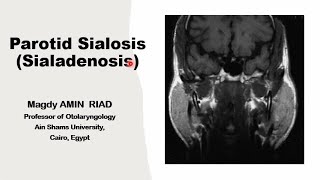 Parotid Sialosis Salivary Sialoadenosis [upl. by Neslund874]