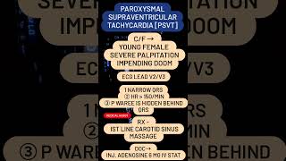 PAROXYSMAL SUPRAVENTRICULAR TACHYCARDIA PSVT [upl. by Llednahs]