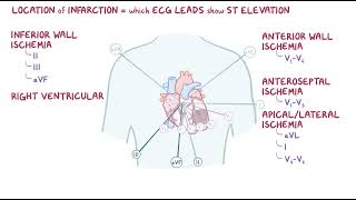 Clinical Reasoning  Coronary Artery Disease  Osmosis [upl. by Liman51]