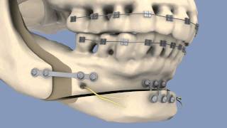 BSSO amp Osseous Genioplasty [upl. by Short702]