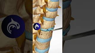 See how an Artificial Cervical Disc Replacement of the Spine works in 3D animation [upl. by Nort939]