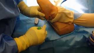 Bone graft small harvesting technique from calcaneus with bone marrow aspiration needle [upl. by Bram]