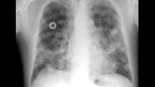 Lung Metastases on Chest X ray [upl. by Oirrad265]