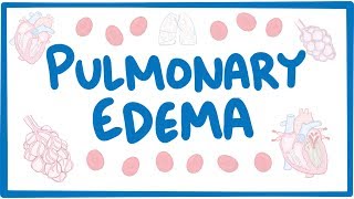 Pulmonary Edema  causes symptoms diagnosis treatment pathology [upl. by Reyem]