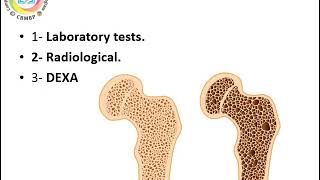 30 osteoporosis basics lecture 29 3 [upl. by Enelrac580]