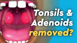 Tonsils and Adenoids Surgery [upl. by Greer504]