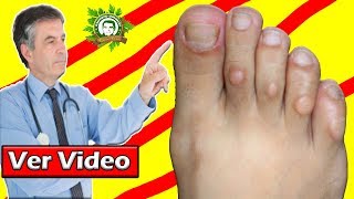 Cómo Tratar Callos en los Pies de Forma Natural ¡Pies Más Bonitos Con ESTOS Buenos Consejos [upl. by Hailat39]