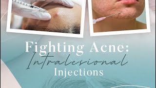 Fighting Acne Intralesional Injections [upl. by Ynohta]