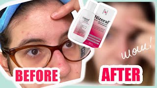 Nizoral Shampoo Against Fungal Acne  Is it Effective [upl. by Stoneman]