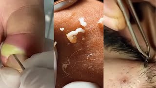 Unleashing Pimple Popper The Ultimate Satisfaction [upl. by Juback]