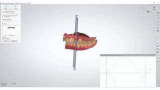 3Shape Ortho Analyzer  How to Measure Overjet and Overbite [upl. by Noryv]