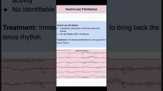 Ventricular Fibrillation [upl. by Yrian]