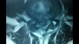 Brain and Spine surgery very large herniated disc L4L5 [upl. by Seda797]