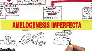 Amelogenesis Imperfecta  Pathogenesis Types Clinical features and Treatment [upl. by Mathilde]