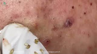 Big Cystic Acne Blackheads Extraction Blackheads amp Milia Whiteheads Removal Pimple Popping [upl. by Nos]