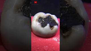 Restauración dental satisfying [upl. by Ahsier213]