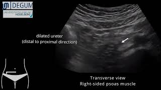 Episode 37 NephroUrolithiasis [upl. by Coe239]