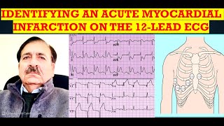 IDENTIFYING AN ACUTE MYOCARDIAL INFARCTION ON THE 12 LEAD ECG  Lectures by Dr Alamzeb [upl. by Goldfarb416]