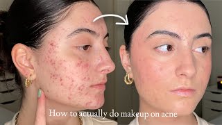 How to Make Makeup Look Smooth amp Natural on Acne and Textured Skin [upl. by Wootten120]