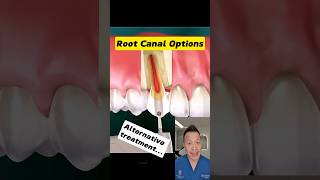 Top 4 Root Canal Alternatives You Should Know dentallan dentist shorts [upl. by Nalaf329]