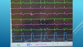 7 Pericardiocentesis  Confirming Location [upl. by Rialc]