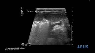 Pyloric Stenosis NLS Video [upl. by Jaynes]