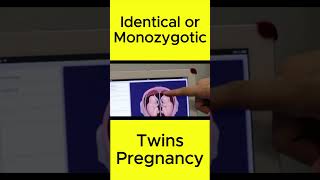 Identical or Monozygotic Twins Pregnancy  Judwa Bachy shorts shortvideo [upl. by Sudnor643]