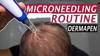 My Microneedling Routine and Derma Rolling for Hair Loss [upl. by Maighdlin]