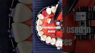 Braces Technique For Tooth Position Correction [upl. by Wei]