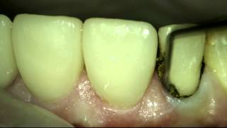 Gingival retraction [upl. by Erdnaxela927]