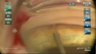 iStent Trabecular MicroBypass Implantation Ike Ahmed [upl. by Swiercz788]