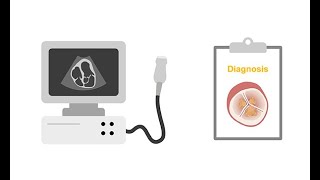 Assessing endocarditis with echocardiography [upl. by Ahsinoj]