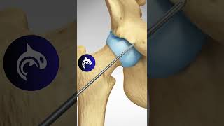 See how a Pincer Impingement of the Hip is repaired  3D Animation [upl. by Rebhun]