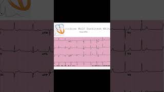 Cómo Identificar el Síndrome de WPW en un Electrocardiograma  Dr José Mario Porto [upl. by Stieglitz]