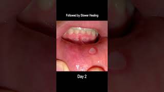 Aphthous Ulcer Time Lapse From Development to Healing Cold Sore [upl. by Pasia]