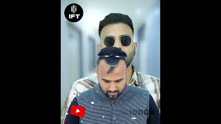 BEST PRP CENTER IN JAIPUR I PRP TREATMENT prptreatment hairtransplant hairfalltreatment [upl. by Jardena]