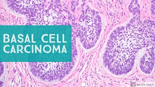 Basal Cell Carcinoma BCC 101  Dermpath Basics Explained by a Dermatopathologist [upl. by Shivers]