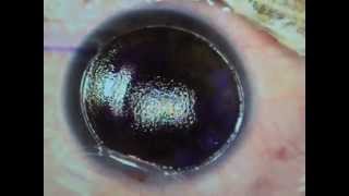 Custom LASIK for Astigmatism Correction [upl. by Nykal39]