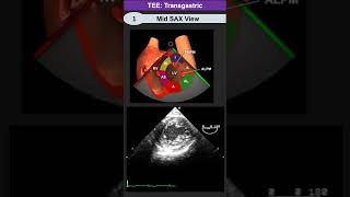 TEE Transgastric Mid SAX View [upl. by Anir]