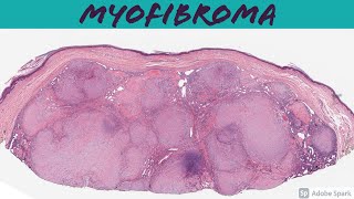 Myofibroma amp Myofibromatosis 101 [upl. by Mello]