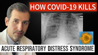 How Coronavirus Kills Acute Respiratory Distress Syndrome ARDS amp COVID 19 Treatment [upl. by Eleaffar]